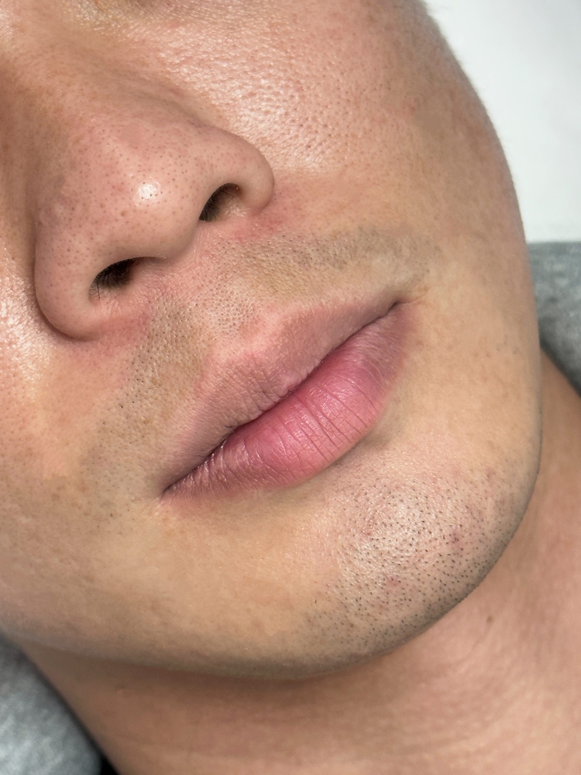 男性霧唇修復一個月後留色
