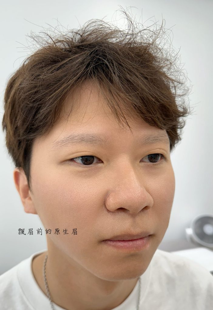 男性飄眉前 天生狀況